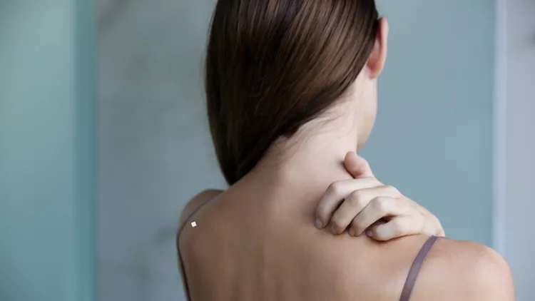 psoriasis woman