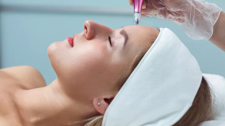 Microneedling με εξωσώματα