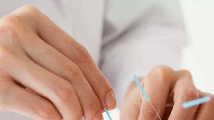 women-receiving-acupuncture-treatment-at-a-hospital-picture-id542566294