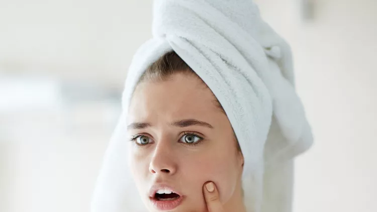 pimple-on-cheek-picture-id543329368