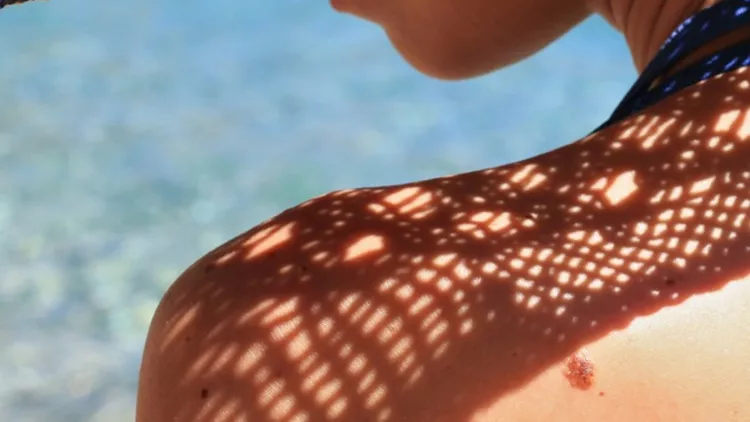 δέρμα ελιές μελάνωμα καρκίνος δέρματος