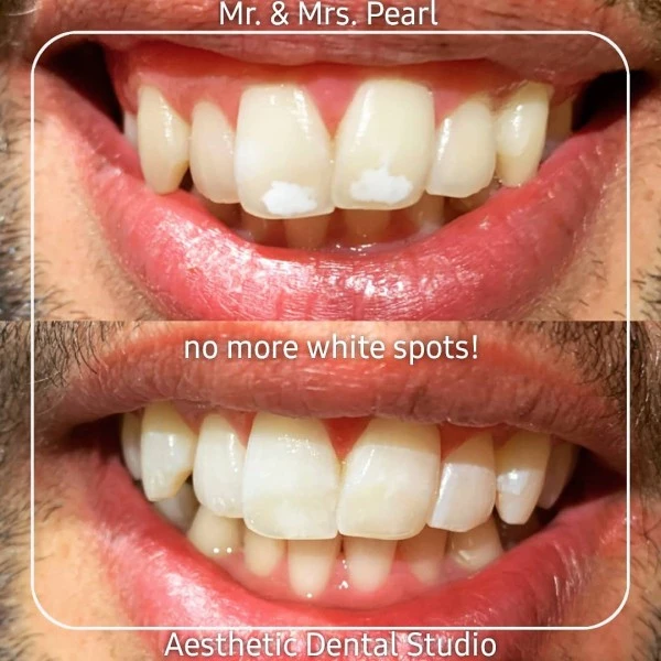 Πώς θα απαλλαγείς από τις λευκές κηλίδες στα δόντια - εικόνα 1